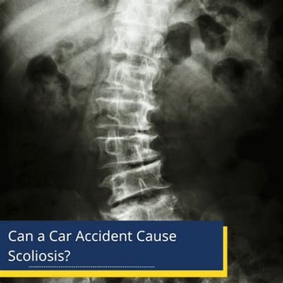 Can a Car Accident Cause Scoliosis? Exploring the Unlikely Connection and Beyond